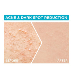 Garnier Fast Clear 4% Salicylic Acid, Vitamin C, Niacinamide, AHA - Anti-Acne Treatment Booster Serum