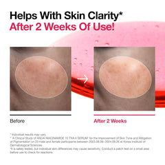 ANUA Niacinamide 10 + TXA 4 Serum, Hyaluronic Acid, Tranexamic acid, Facial Serum For GlassSkin, Glow Back Serum, Dark Spot Care, Postnatal Skincare, Korean Skincare (30ml/1.01 fl.oz)