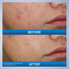 CeraVe Foaming Acne Face and Body Wash with Benzoyl Peroxide, Hyaluronic Acid, and Niacinamide - 5oz