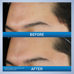 CeraVe Foaming Acne Face and Body Wash with Benzoyl Peroxide, Hyaluronic Acid, and Niacinamide - 5oz