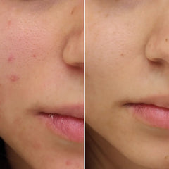 Azeane 15 Percent Azelaic Acid Cream To Acnes, Pigmentation and Dark Spots.